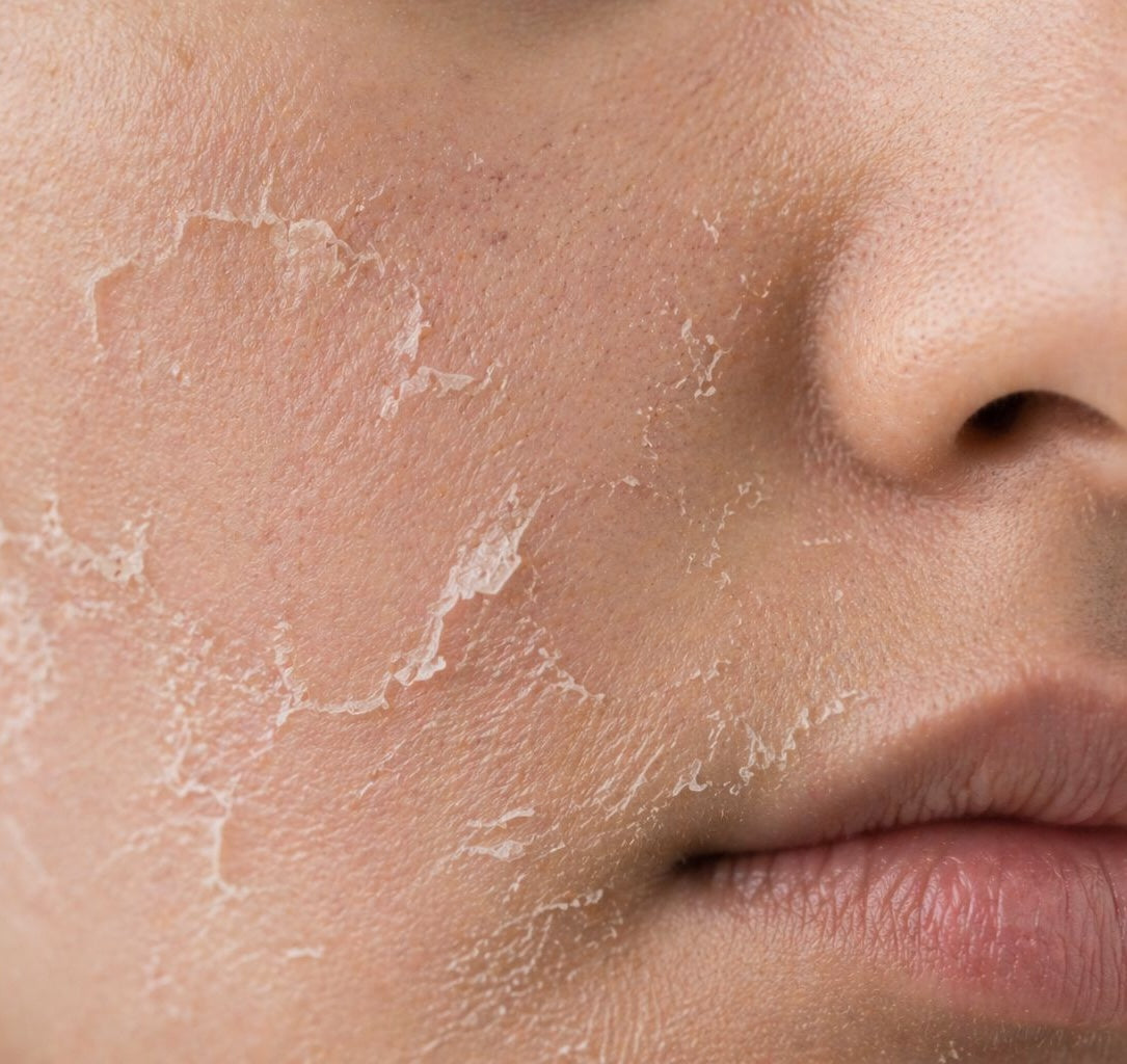 Dull/Dry Skin
