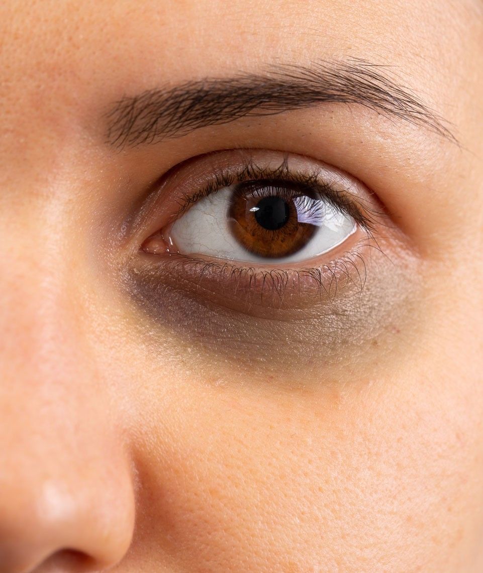 Under Eye Dark Circles & Puffiness