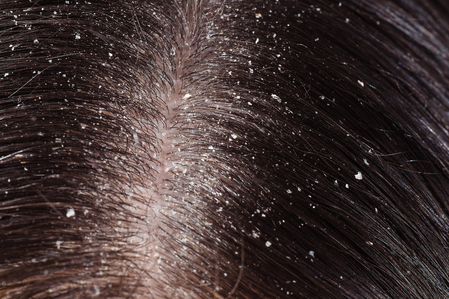 Dandruff