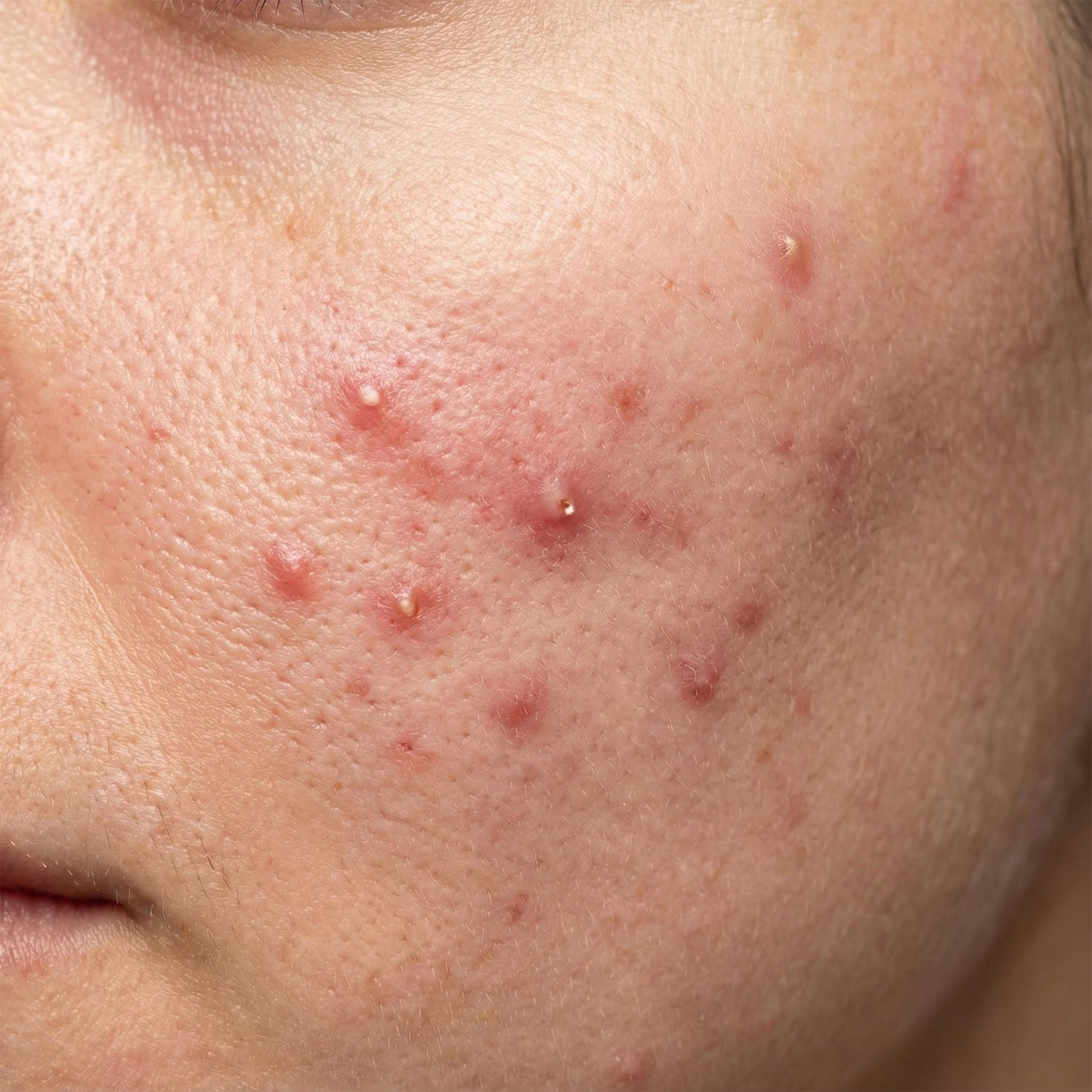 Acne & Breakouts